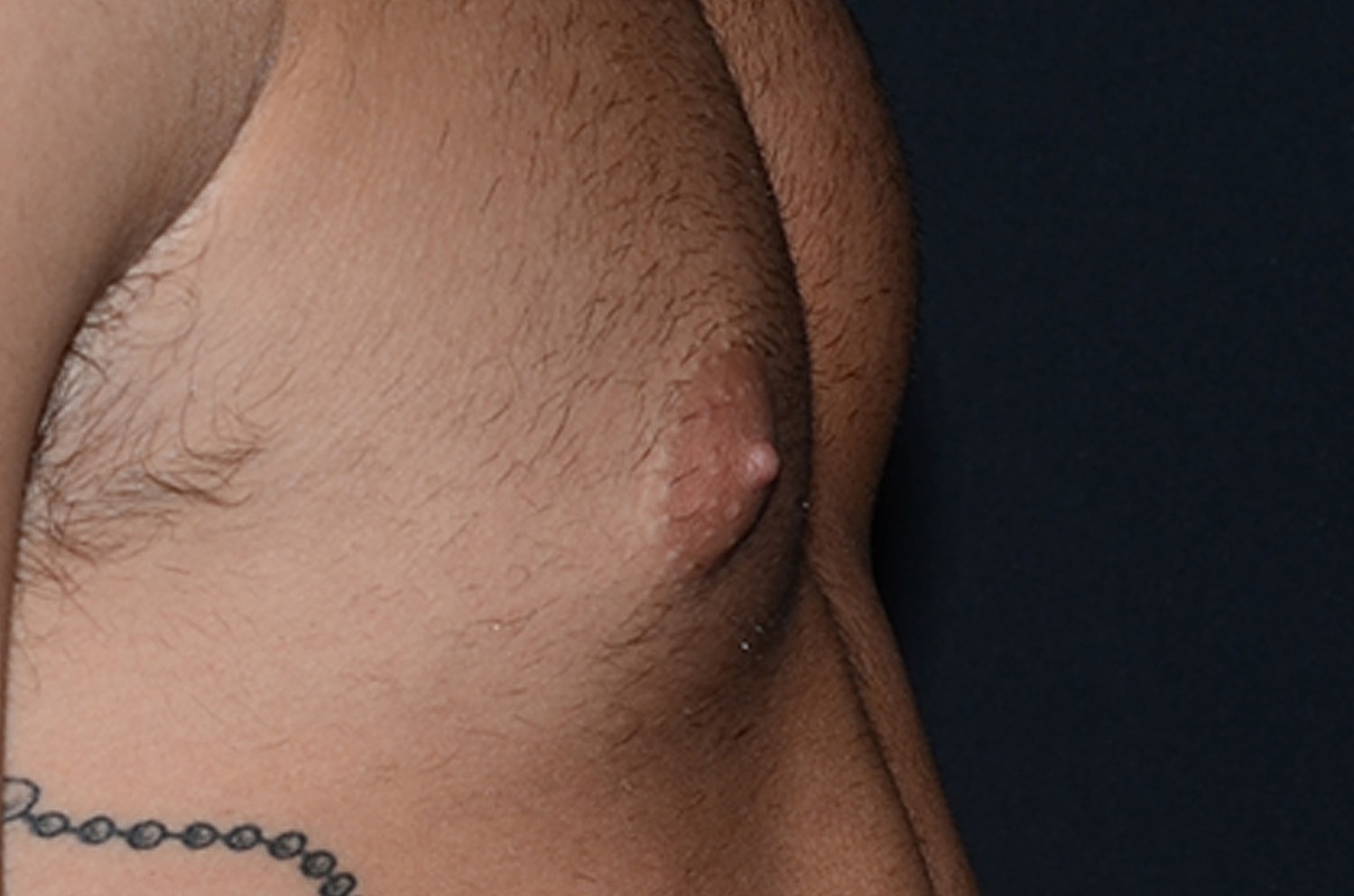 Gynecomastia Before & After