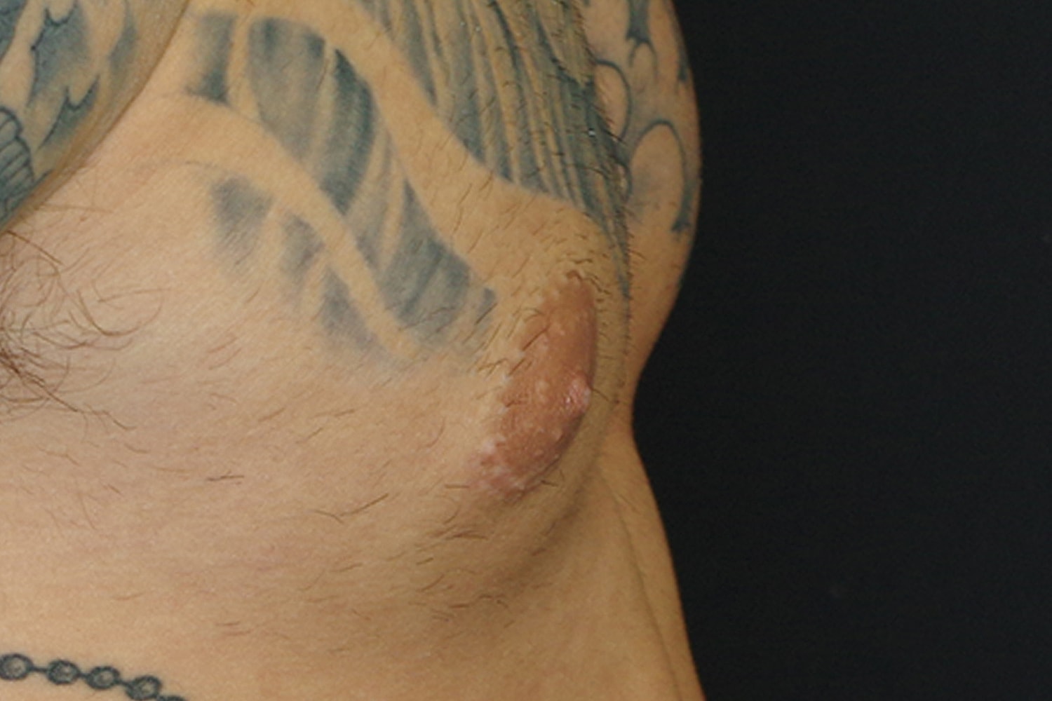 Gynecomastia Before & After