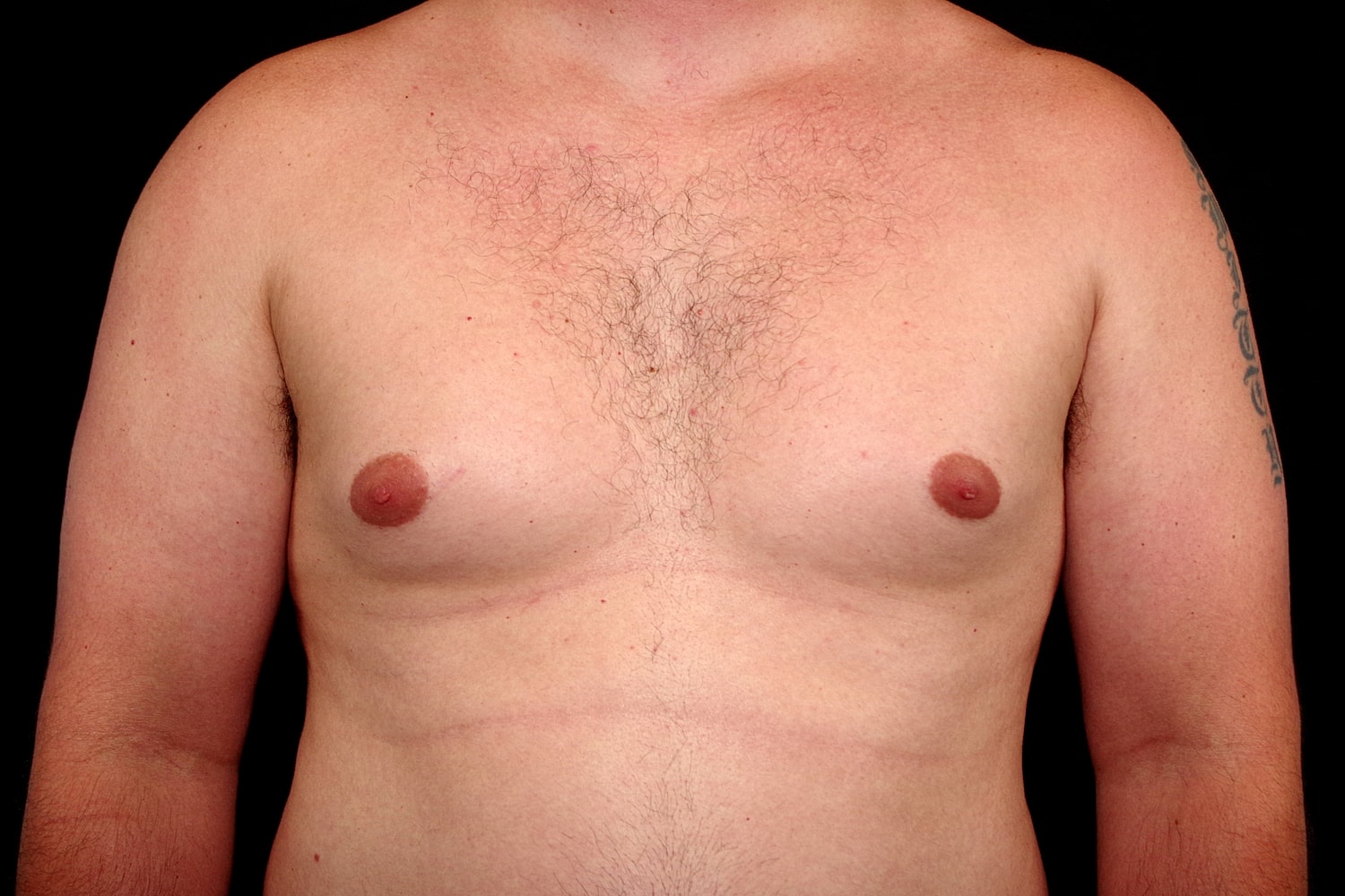 Gynecomastia Before & After