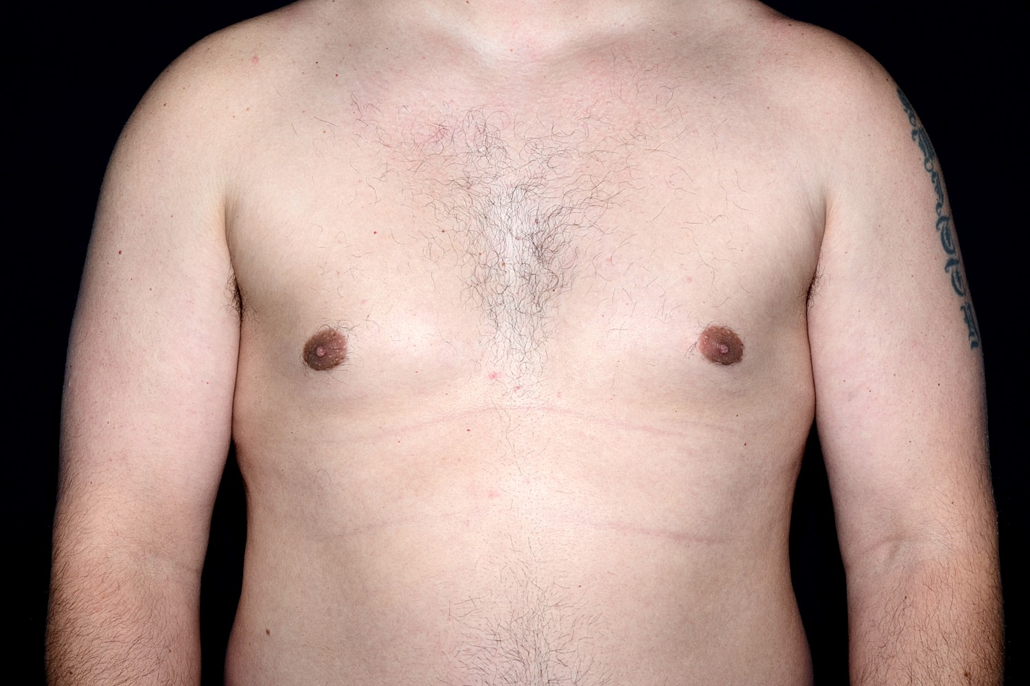 Gynecomastia Before & After