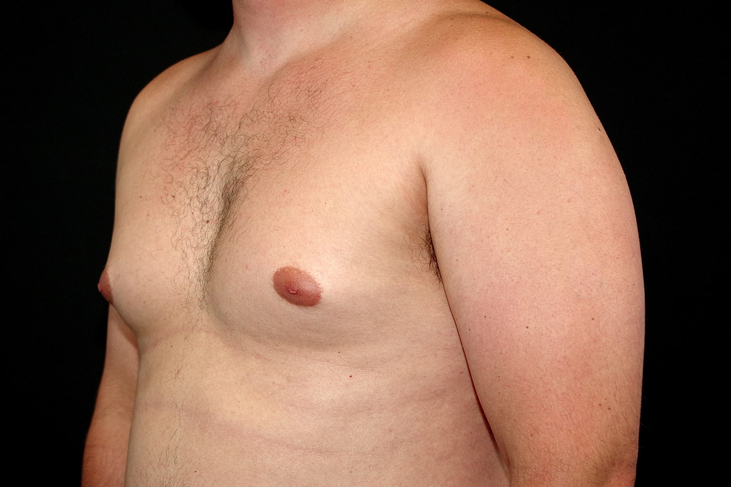 Gynecomastia Before & After