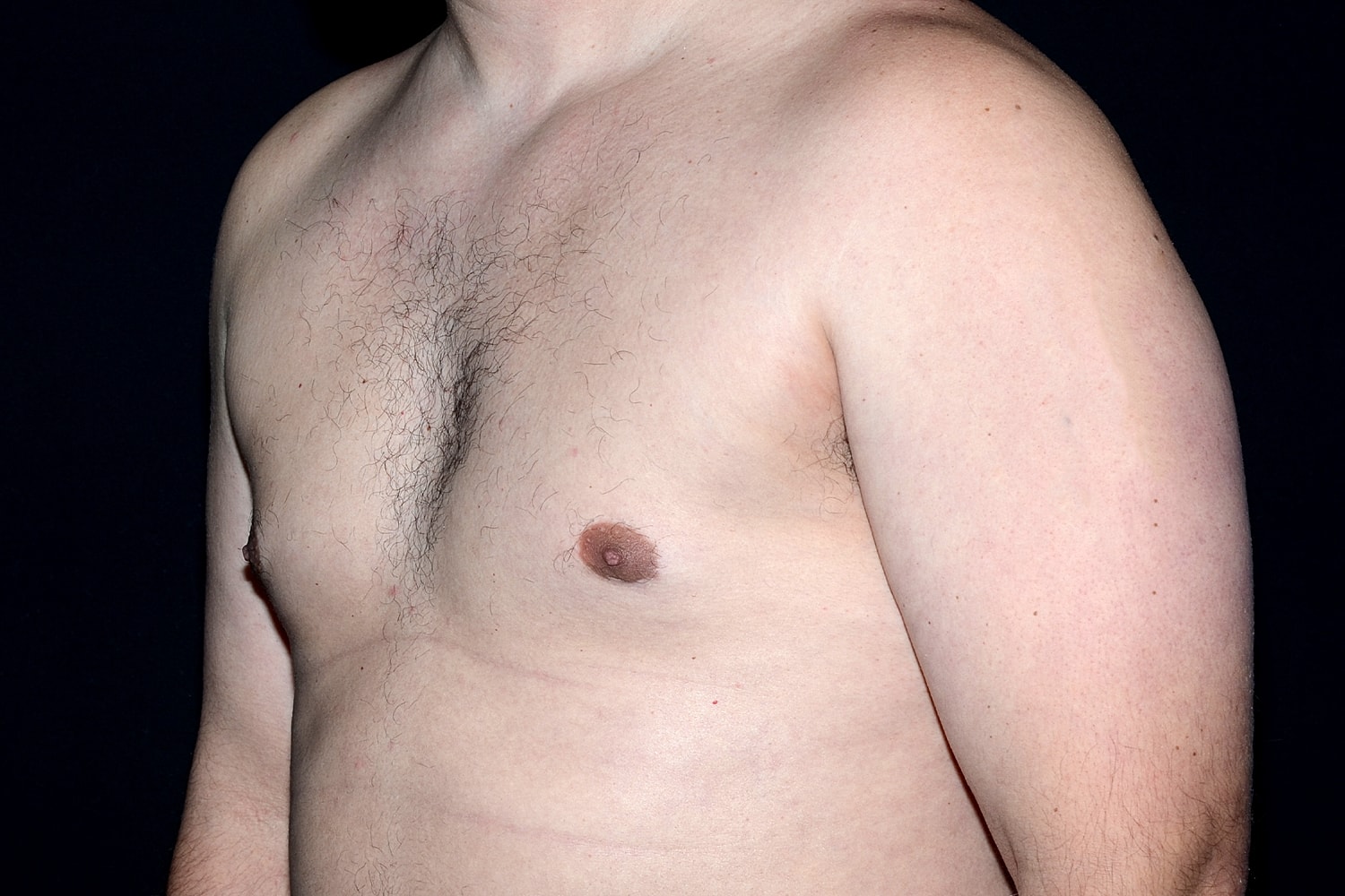 Gynecomastia Before & After