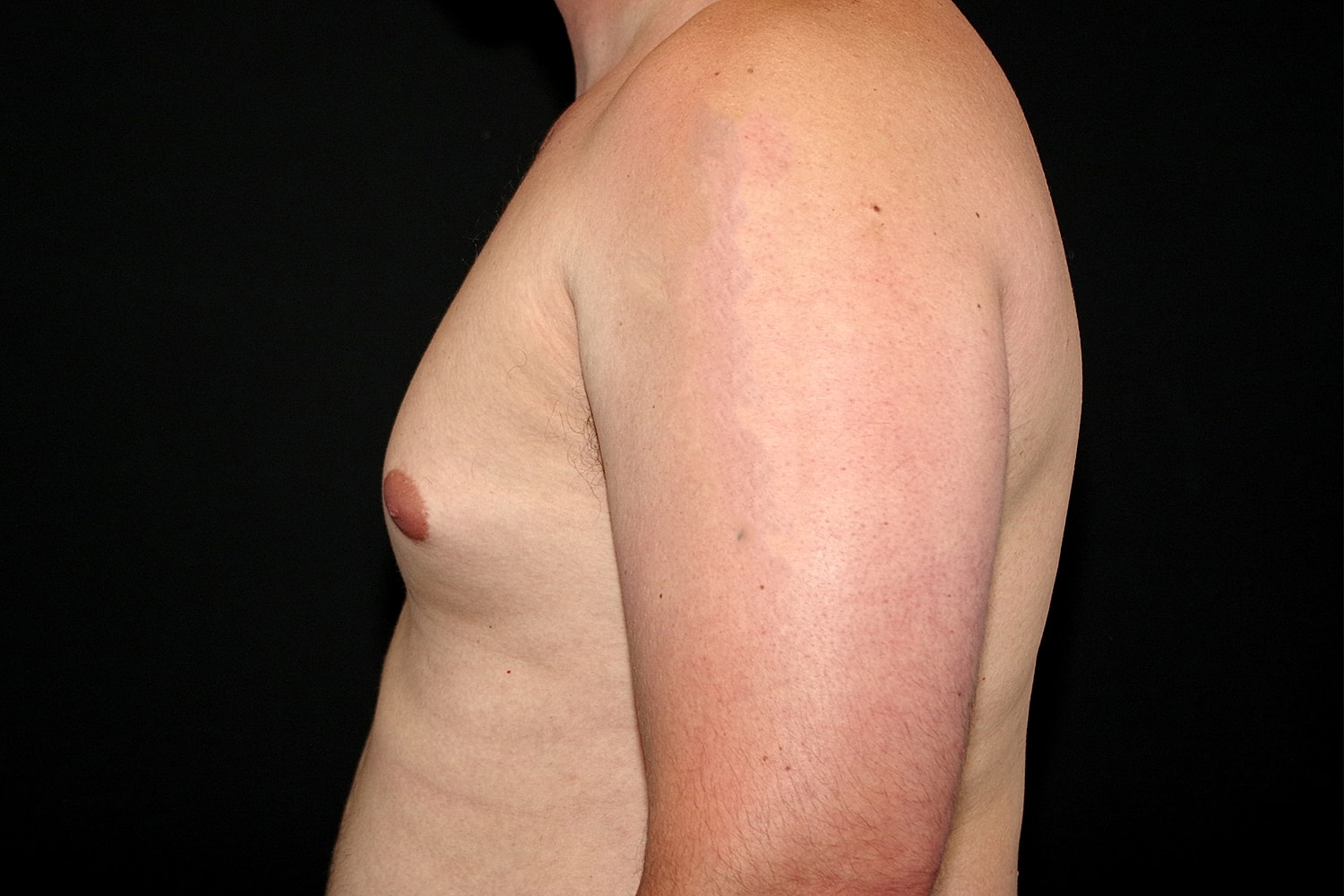 Gynecomastia Before & After