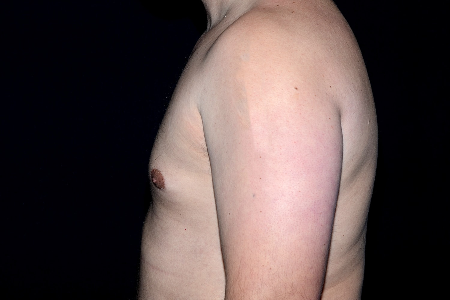 Gynecomastia Before & After