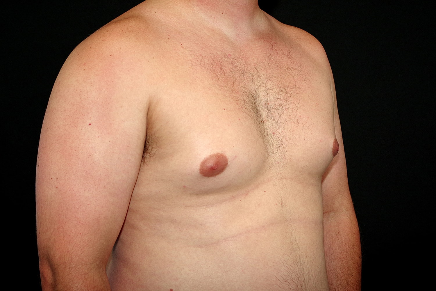 Gynecomastia Before & After