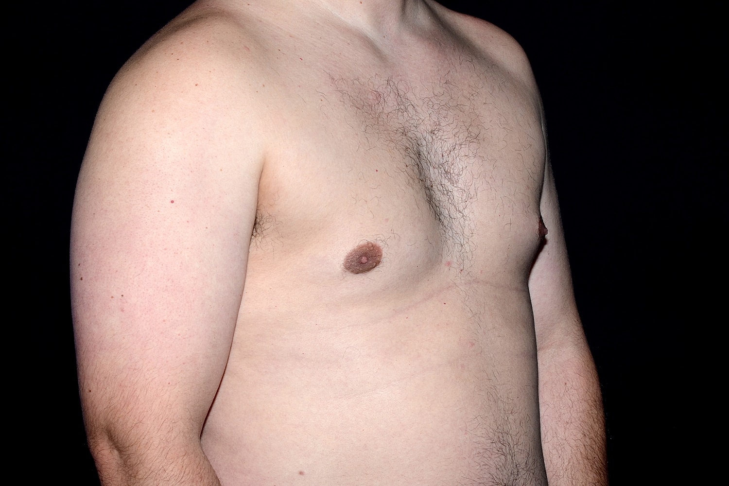 Gynecomastia Before & After