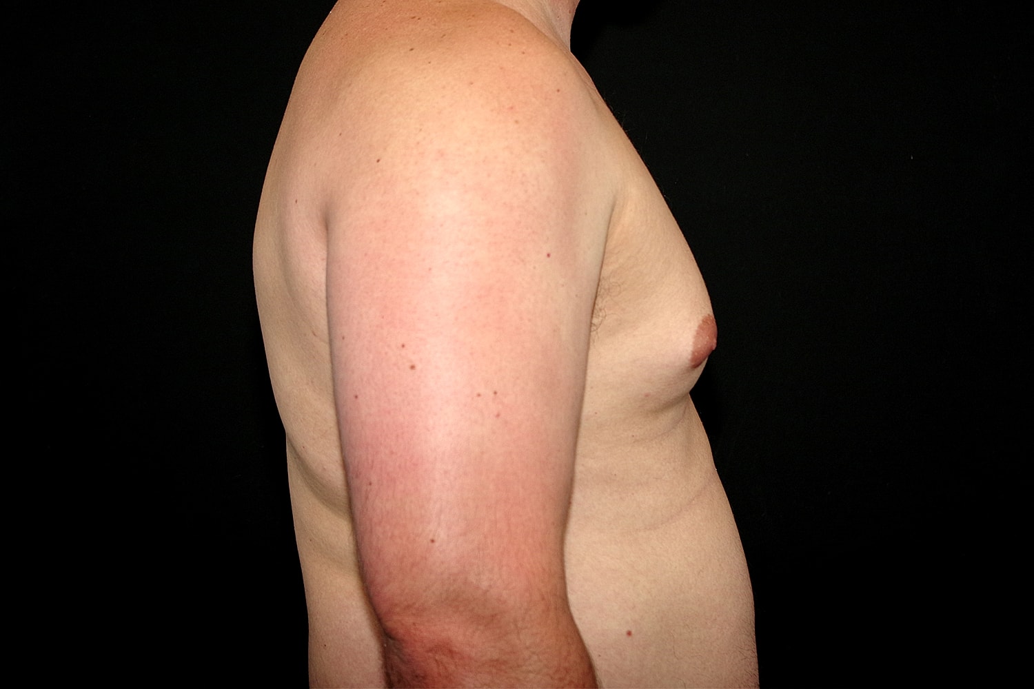 Gynecomastia Before & After