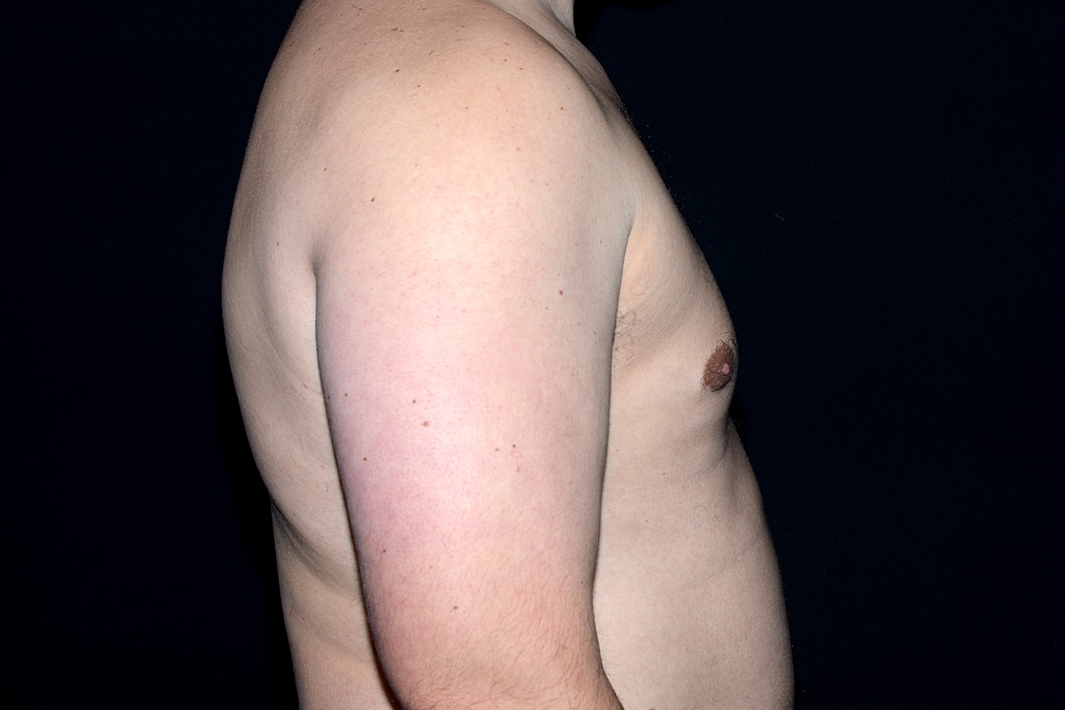 Gynecomastia Before & After