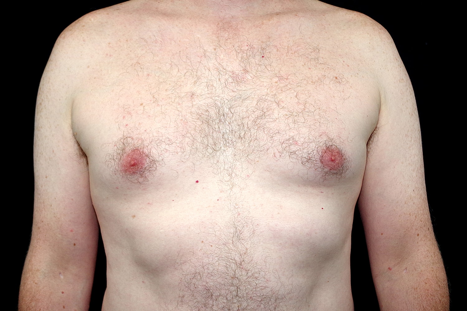 Gynecomastia Before & After