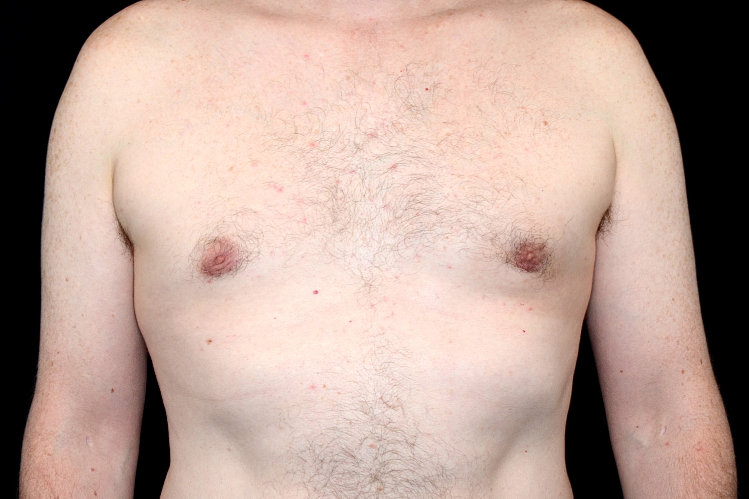 Gynecomastia Before & After
