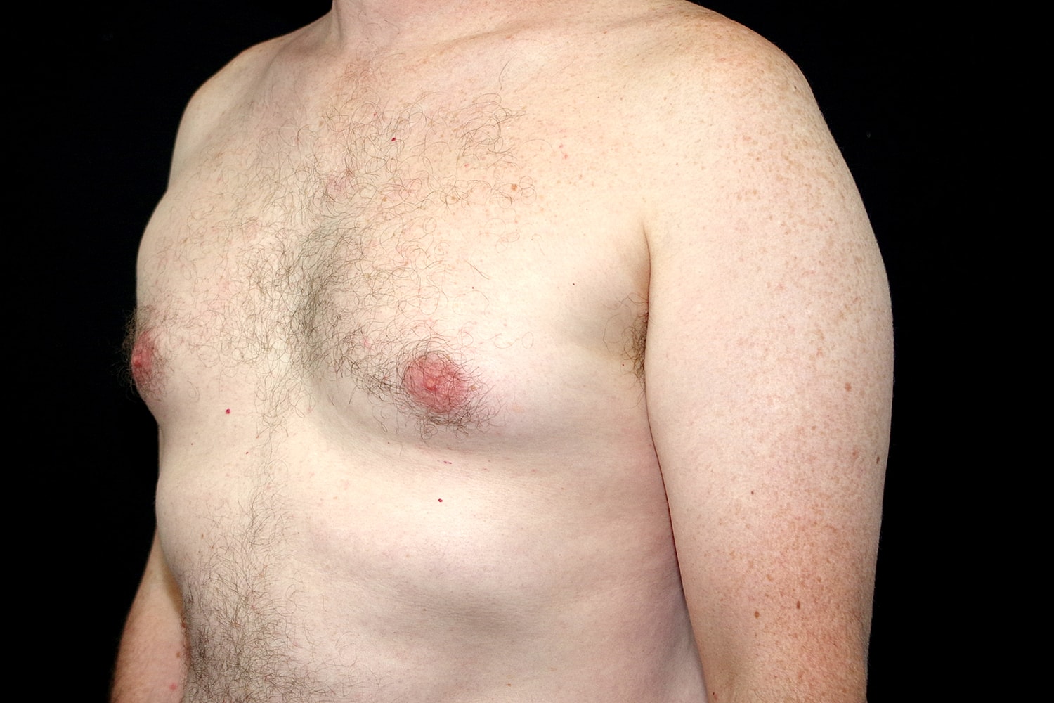 Gynecomastia Before & After