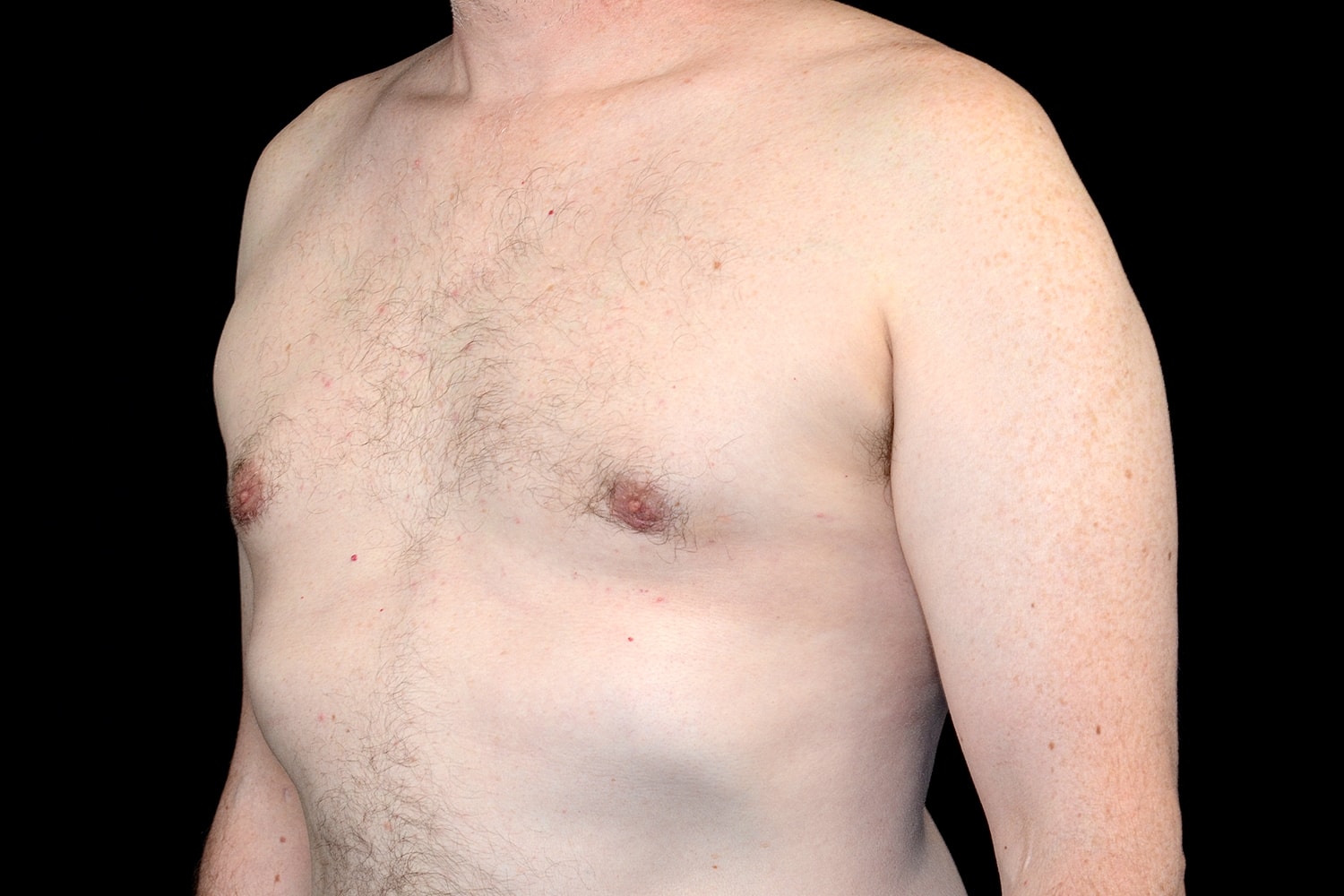 Gynecomastia Before & After