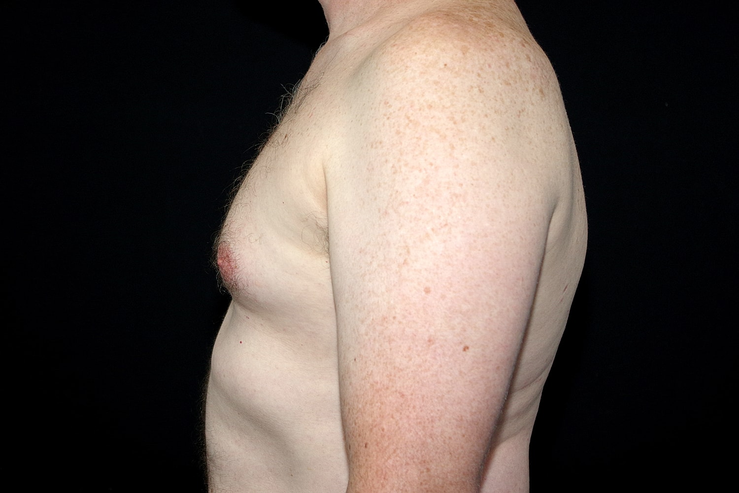 Gynecomastia Before & After