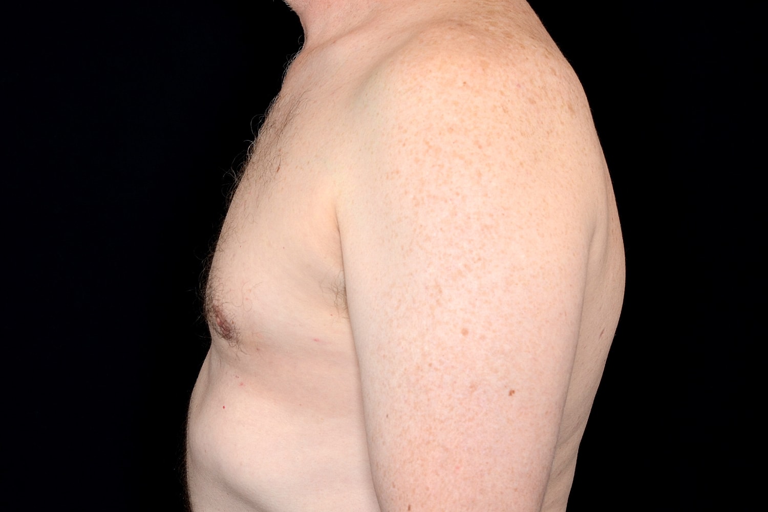 Gynecomastia Before & After