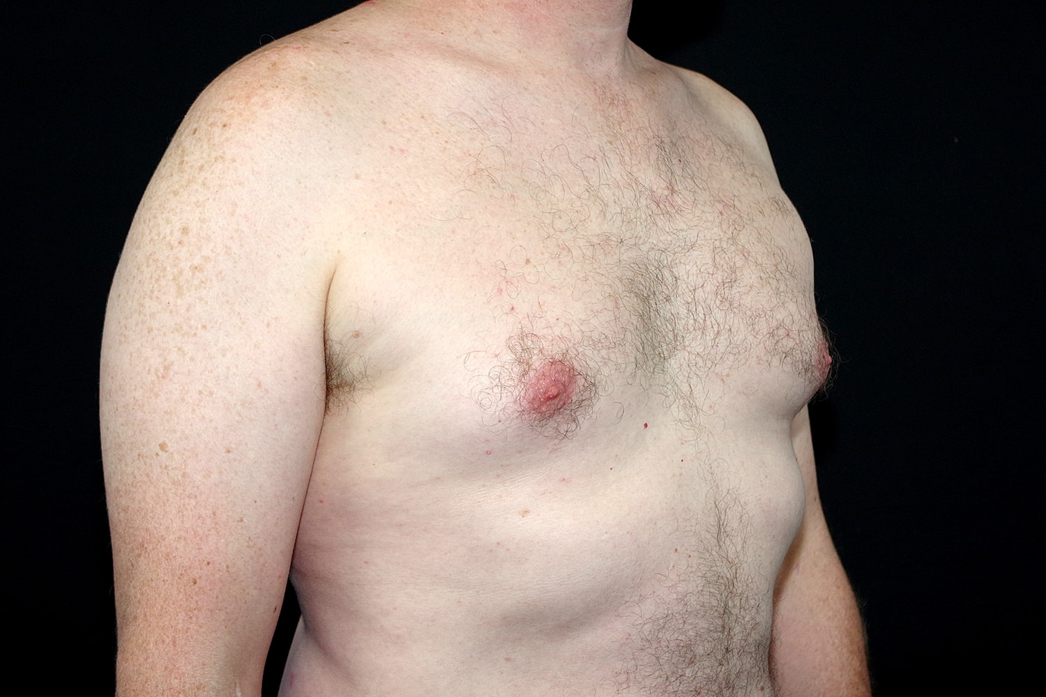 Gynecomastia Before & After