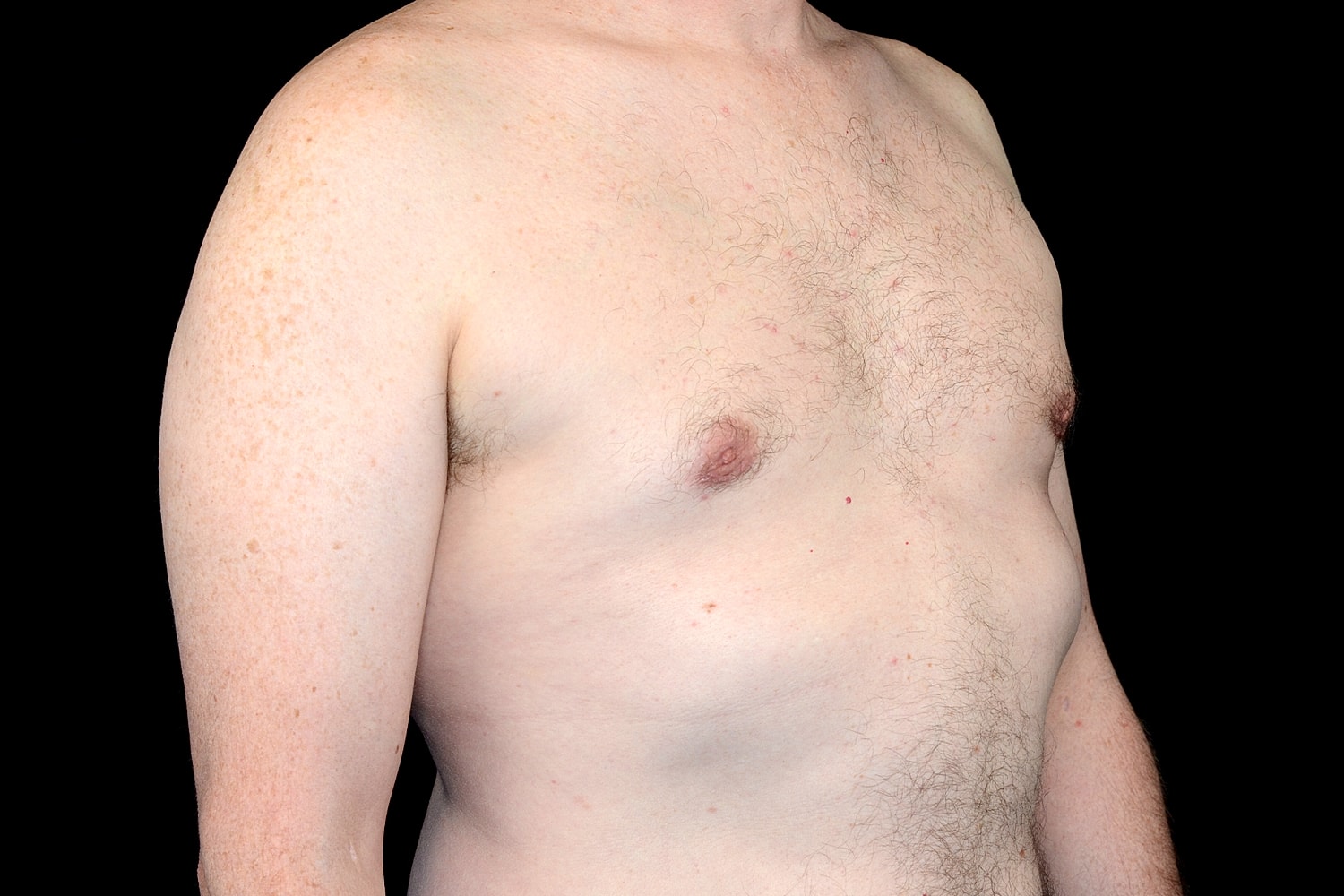 Gynecomastia Before & After