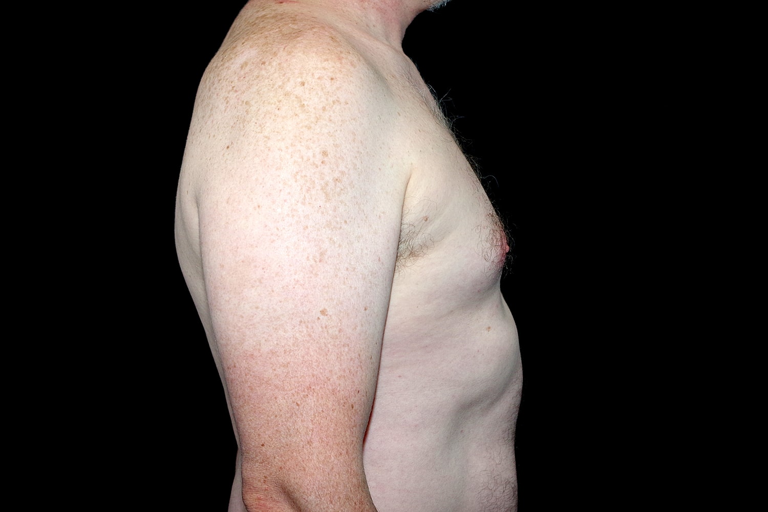 Gynecomastia Before & After