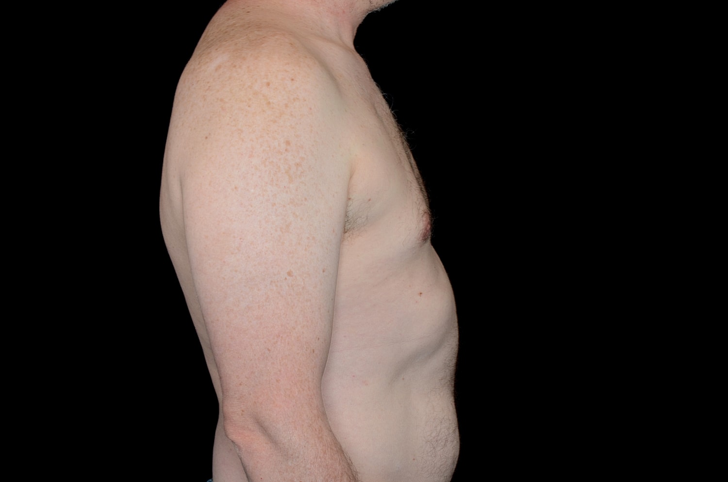 Gynecomastia Before & After