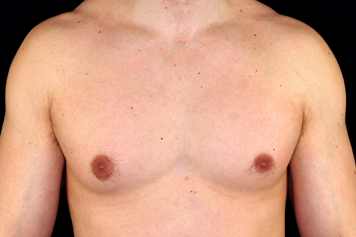 Gynecomastia Before & After