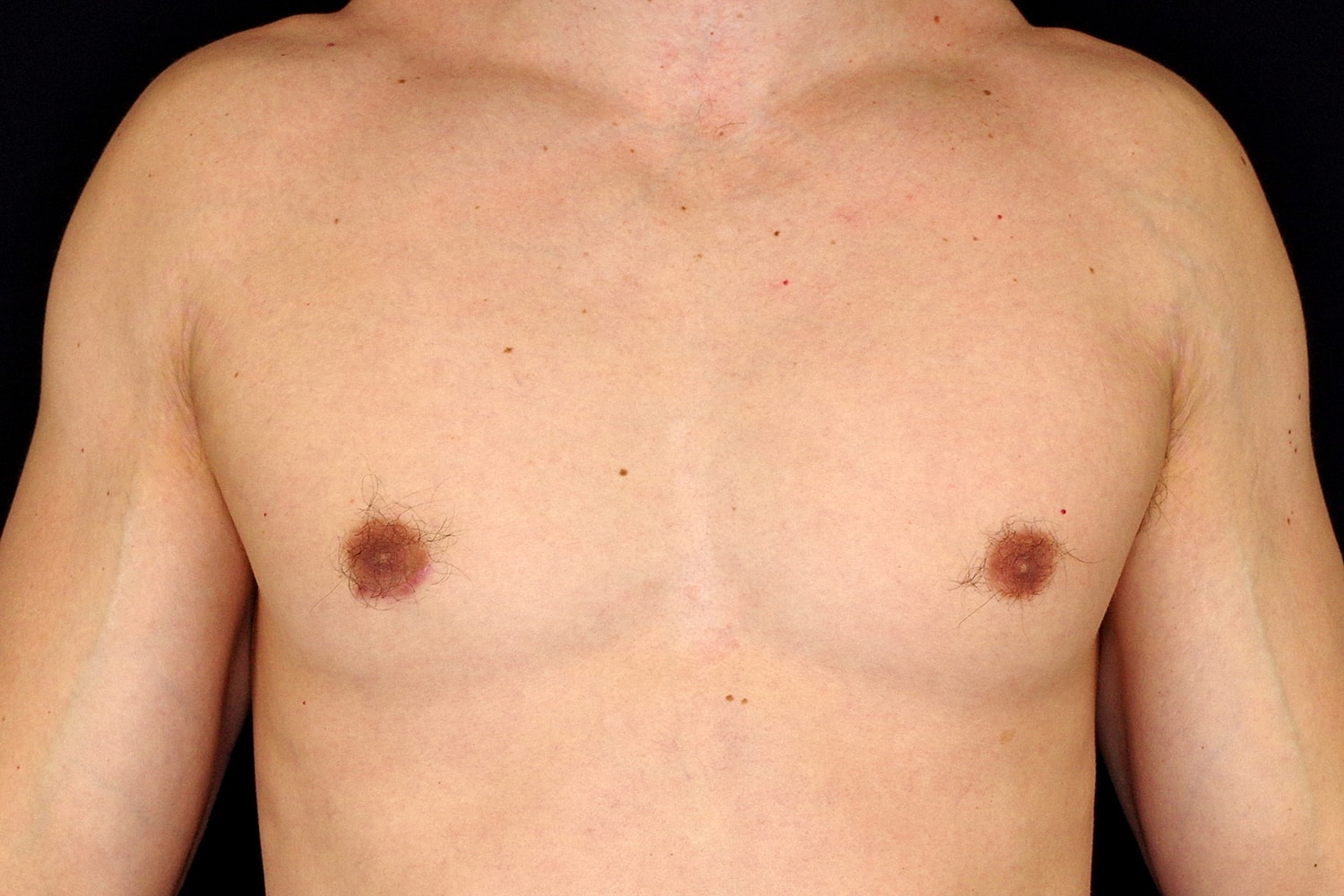 Gynecomastia Before & After