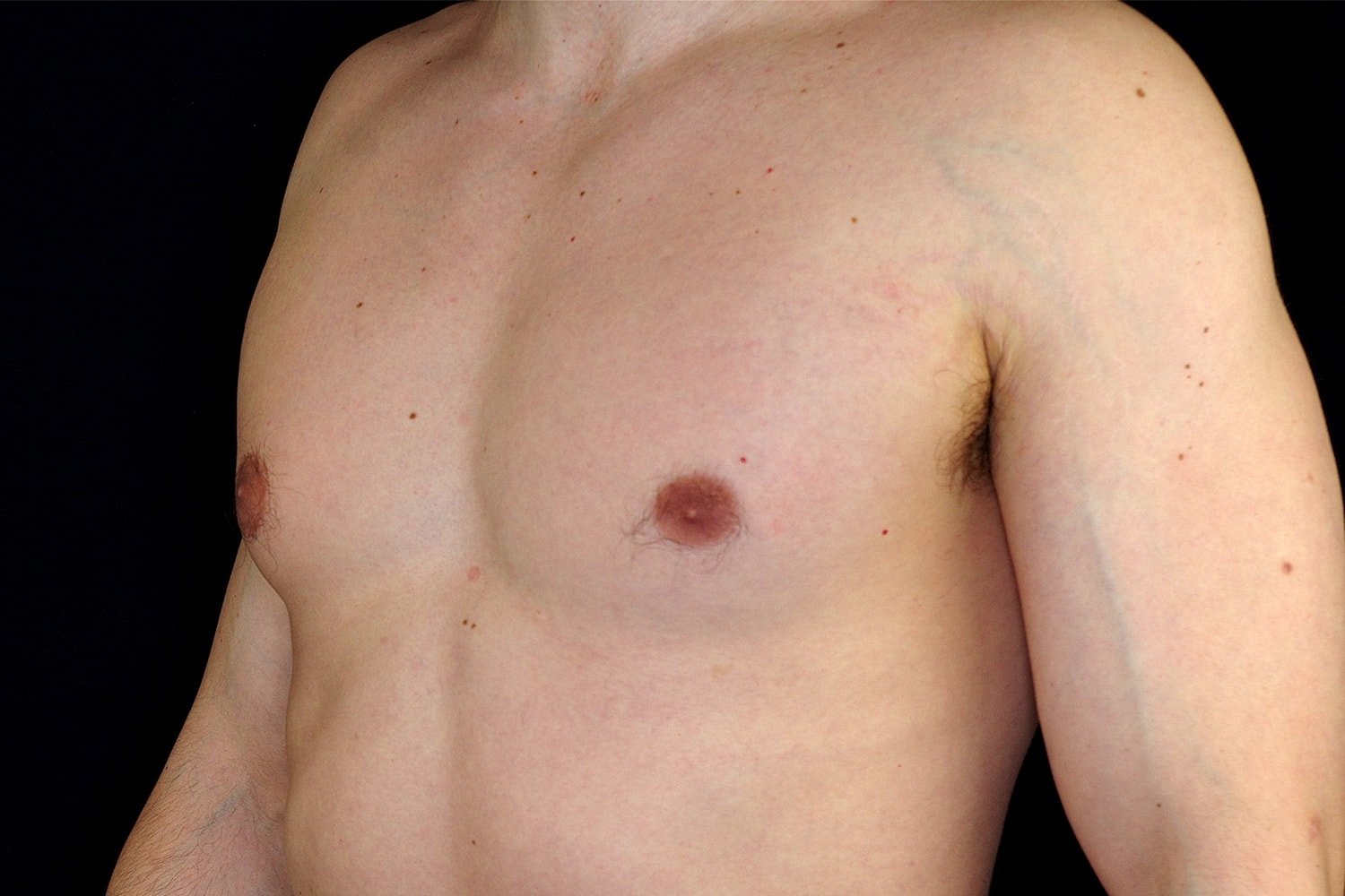 Gynecomastia Before & After