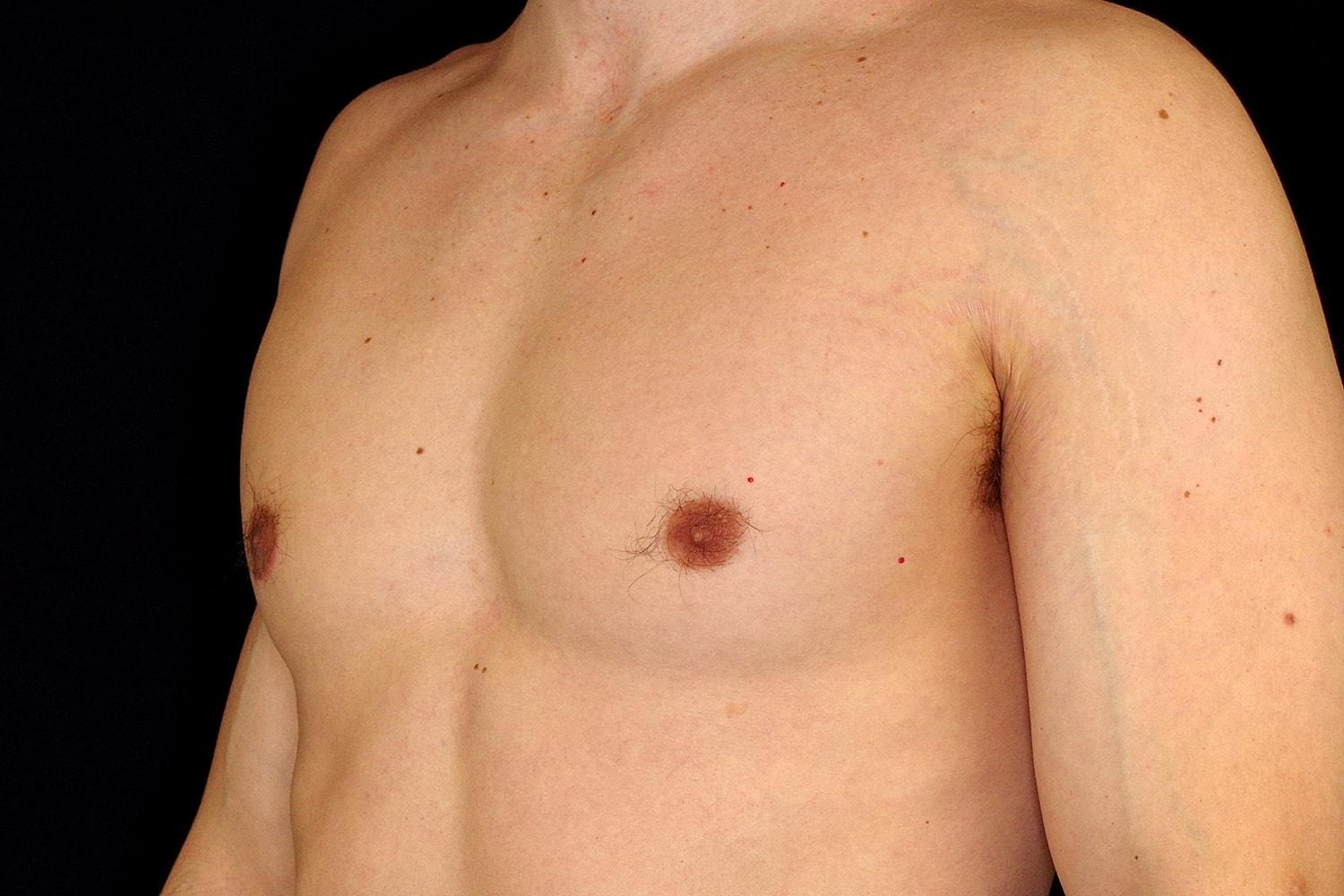 Gynecomastia Before & After
