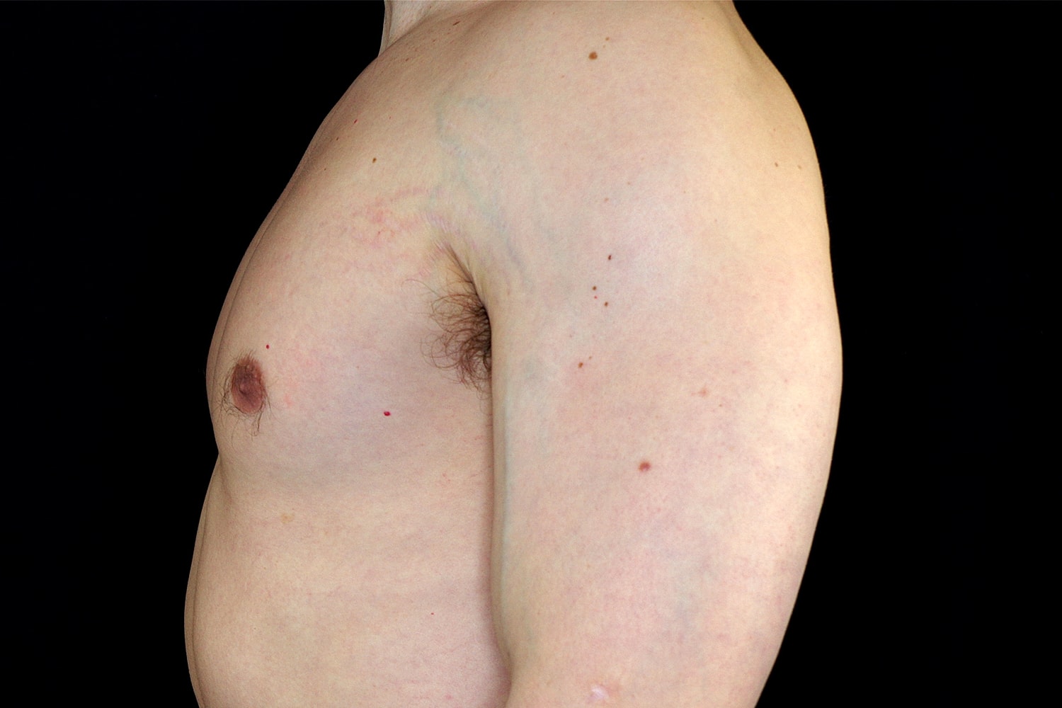 Gynecomastia Before & After