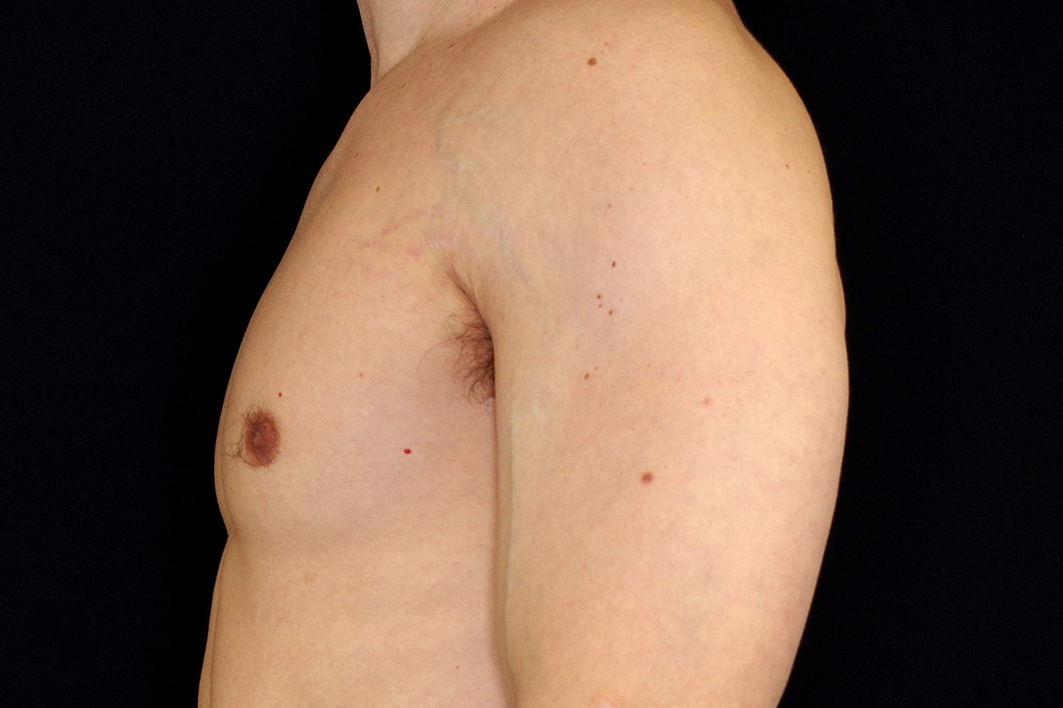 Gynecomastia Before & After