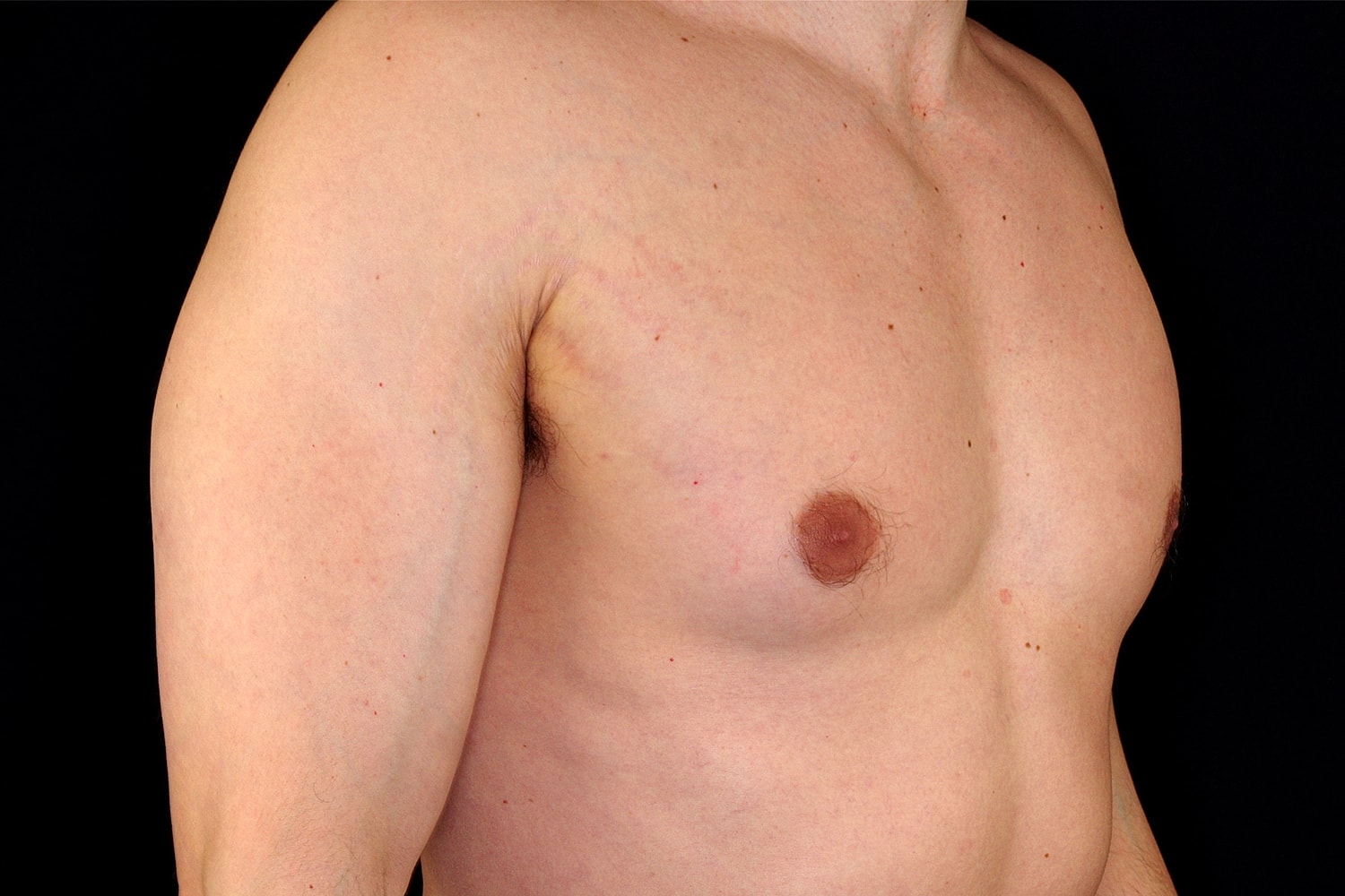 Gynecomastia Before & After