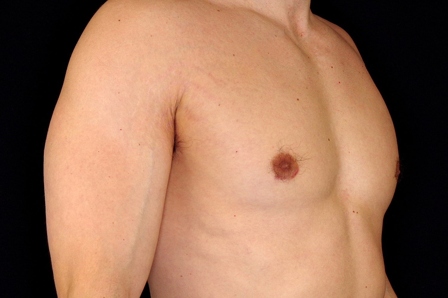 Gynecomastia Before & After