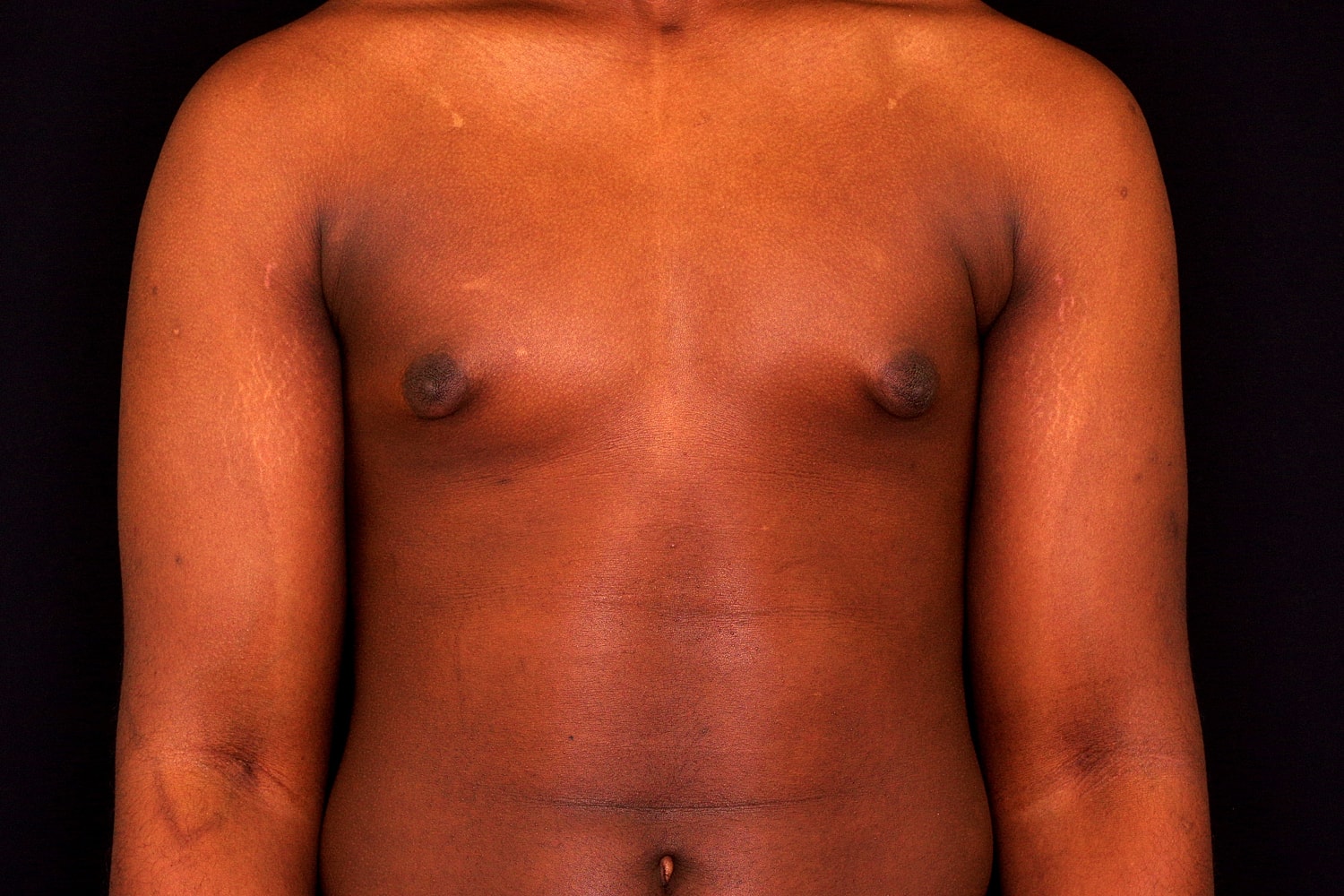 Gynecomastia Before & After