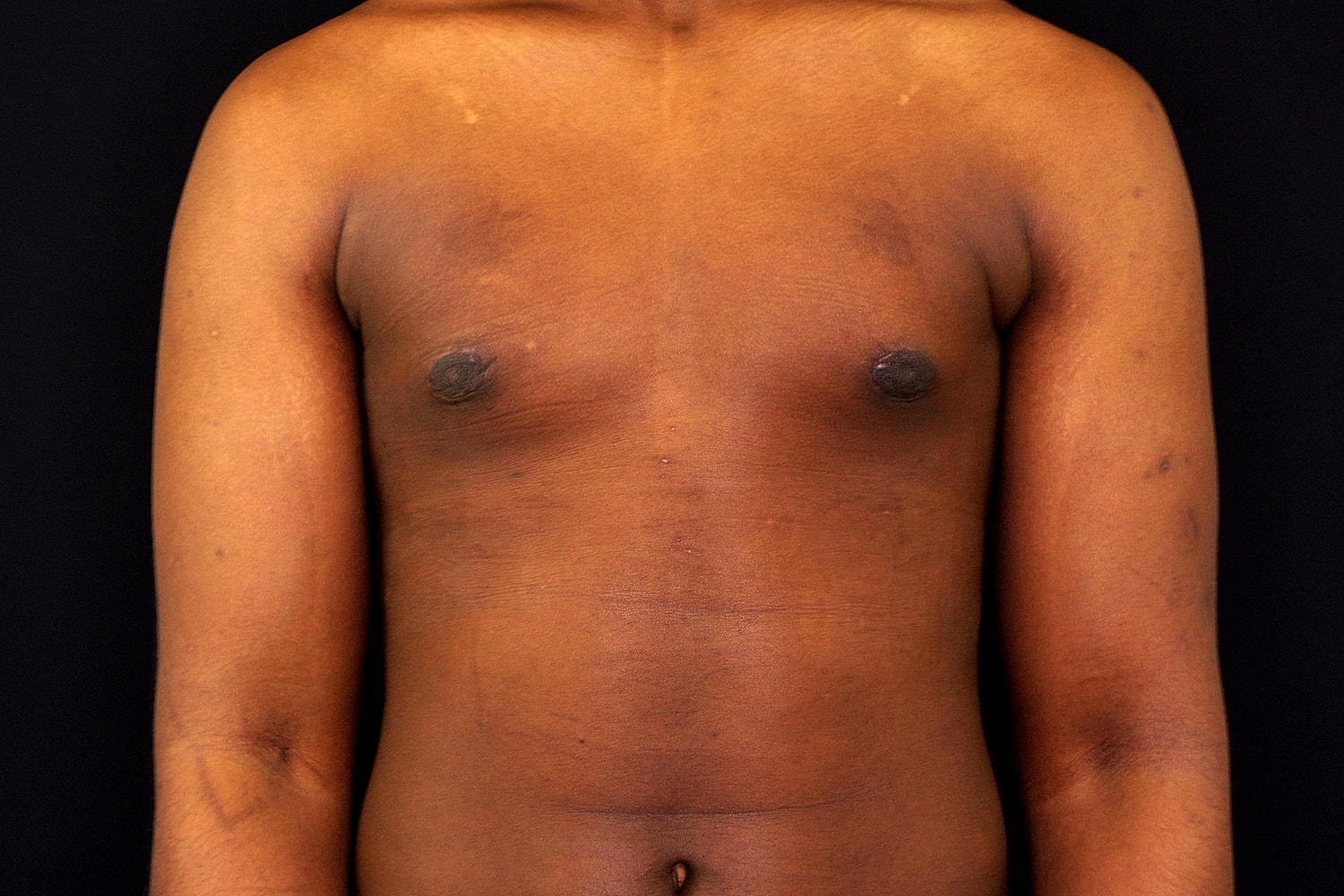 Gynecomastia Before & After