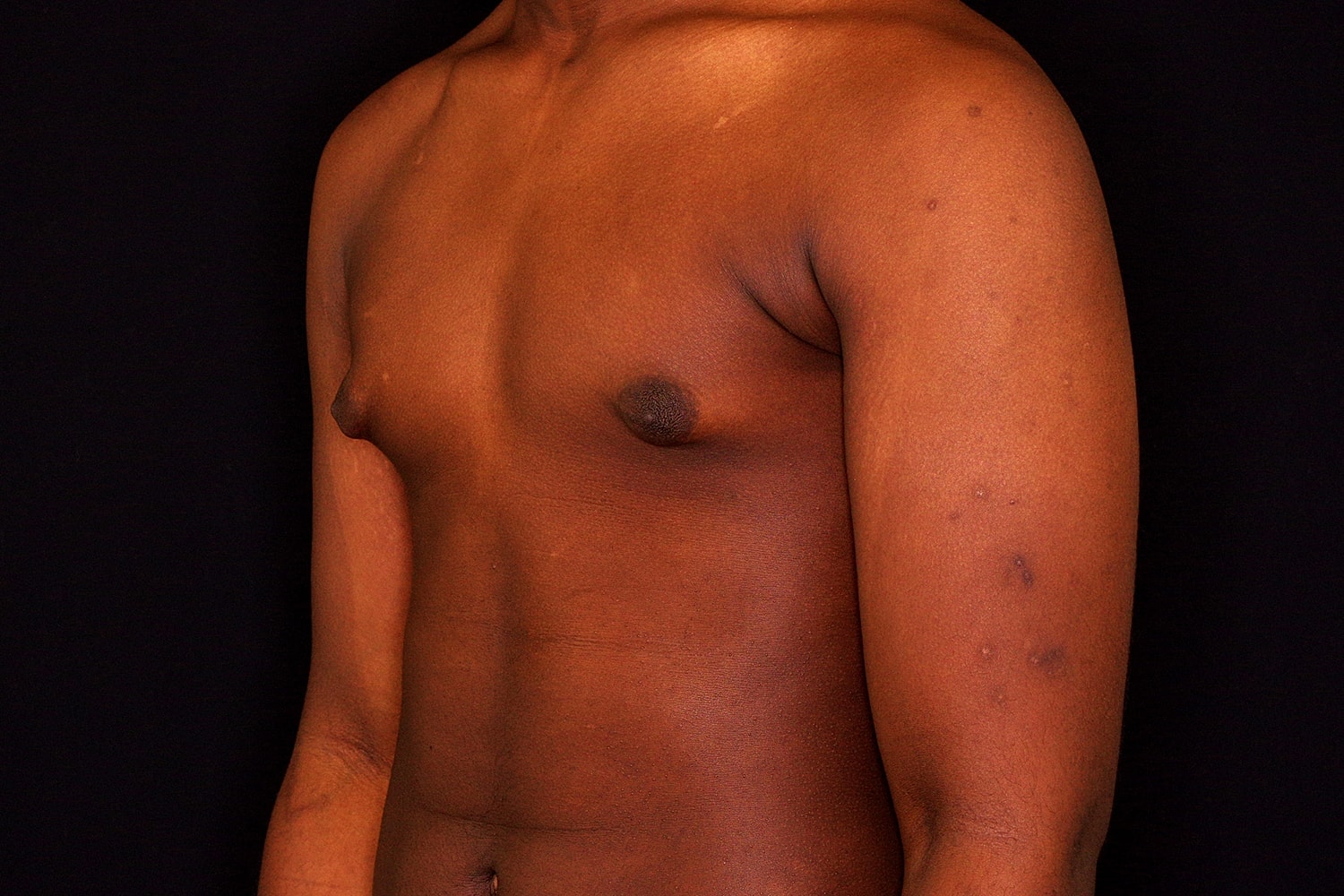 Gynecomastia Before & After