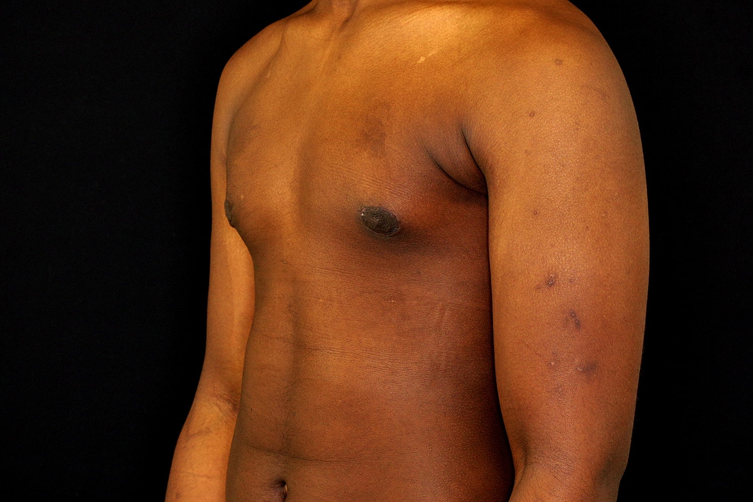 Gynecomastia Before & After