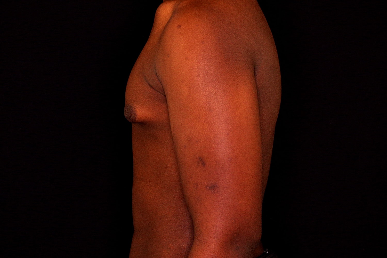 Gynecomastia Before & After