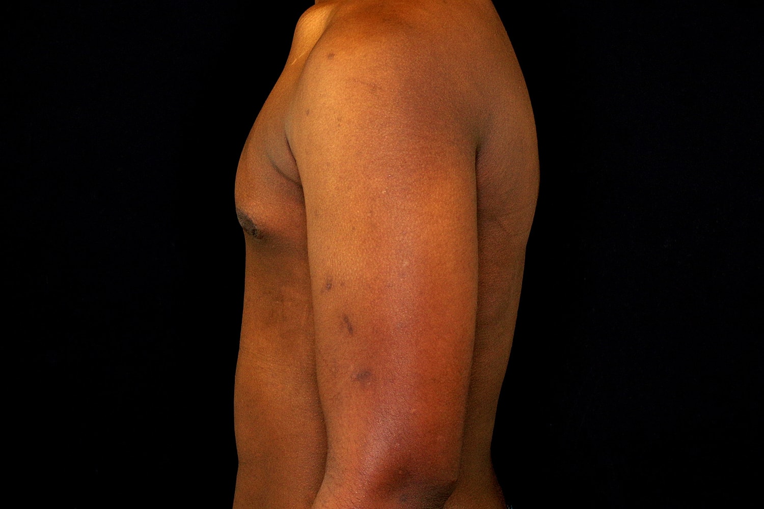 Gynecomastia Before & After