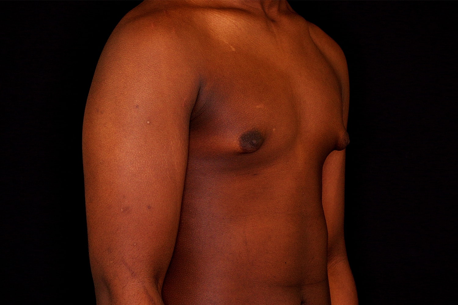 Gynecomastia Before & After