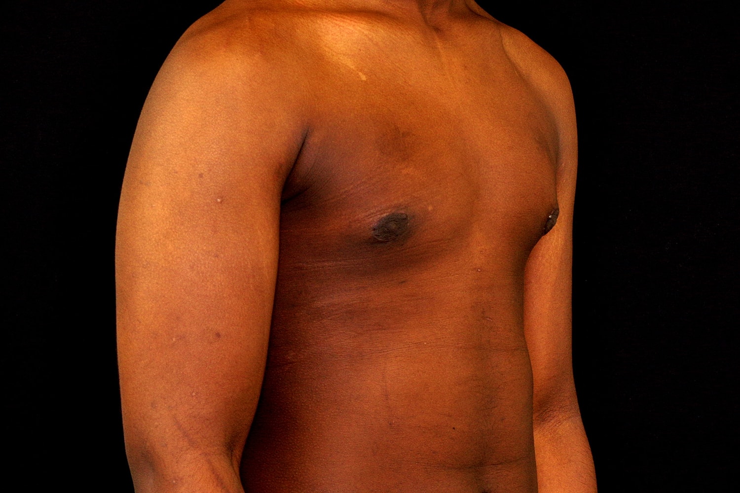 Gynecomastia Before & After