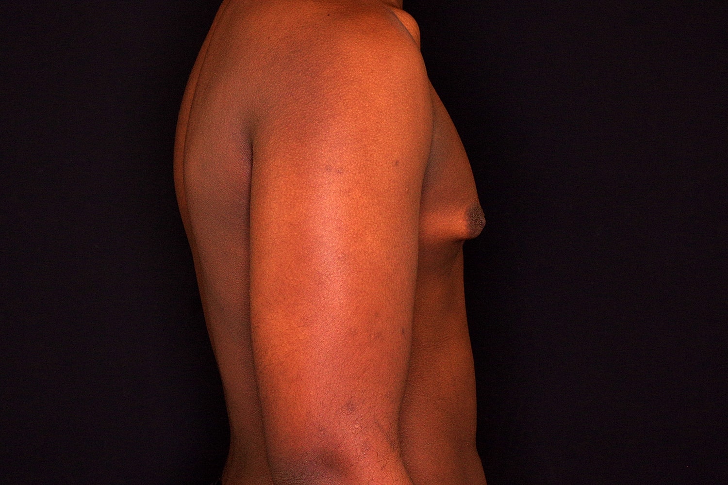 Gynecomastia Before & After