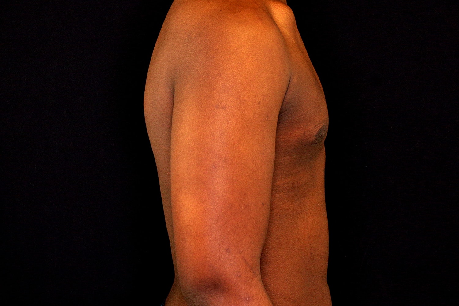 Gynecomastia Before & After