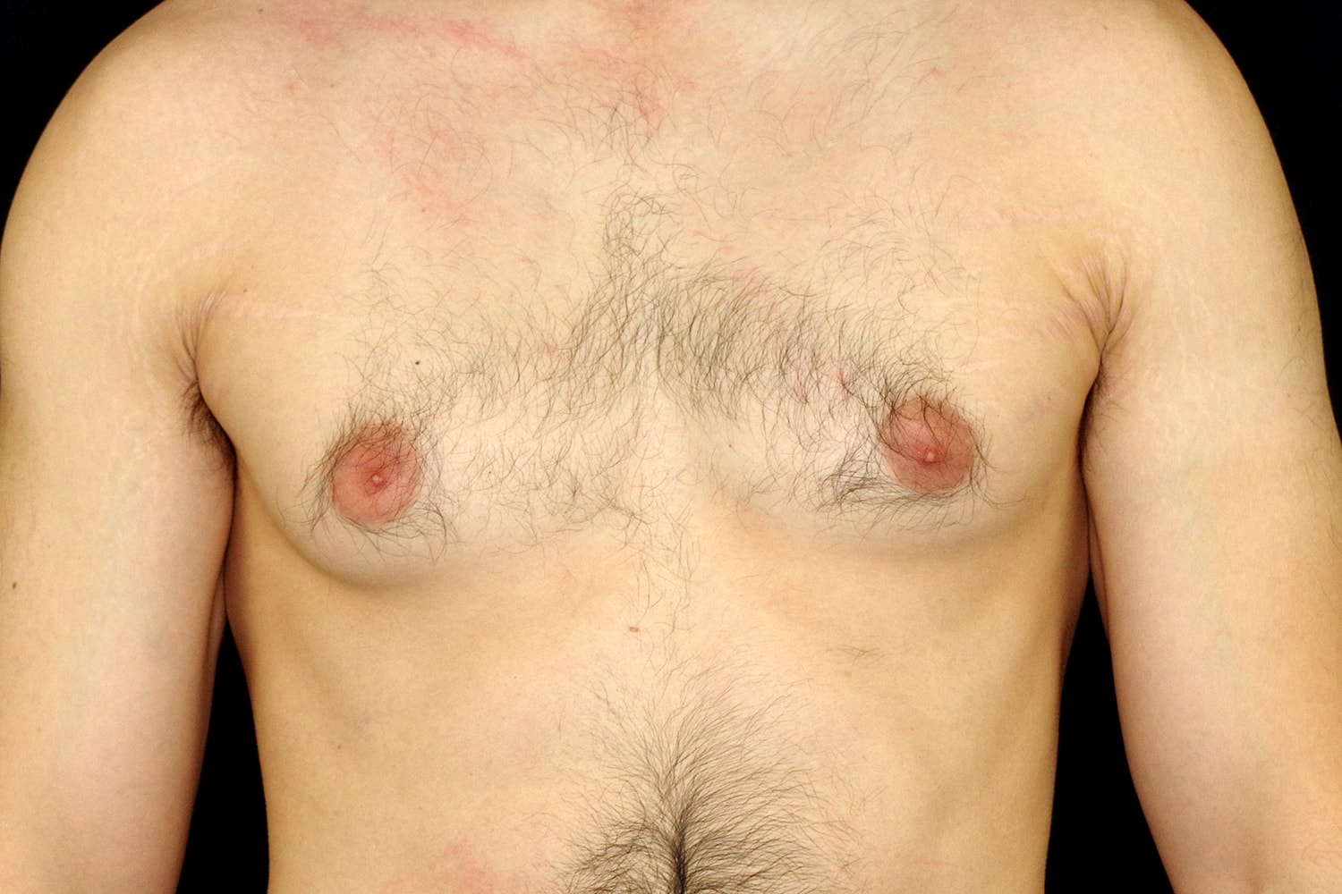 Gynecomastia Before & After