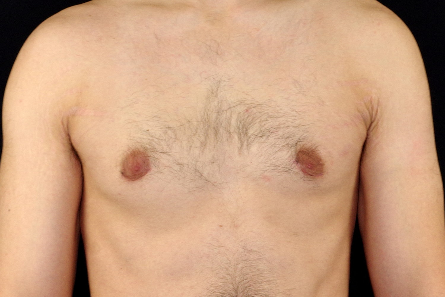 Gynecomastia Before & After
