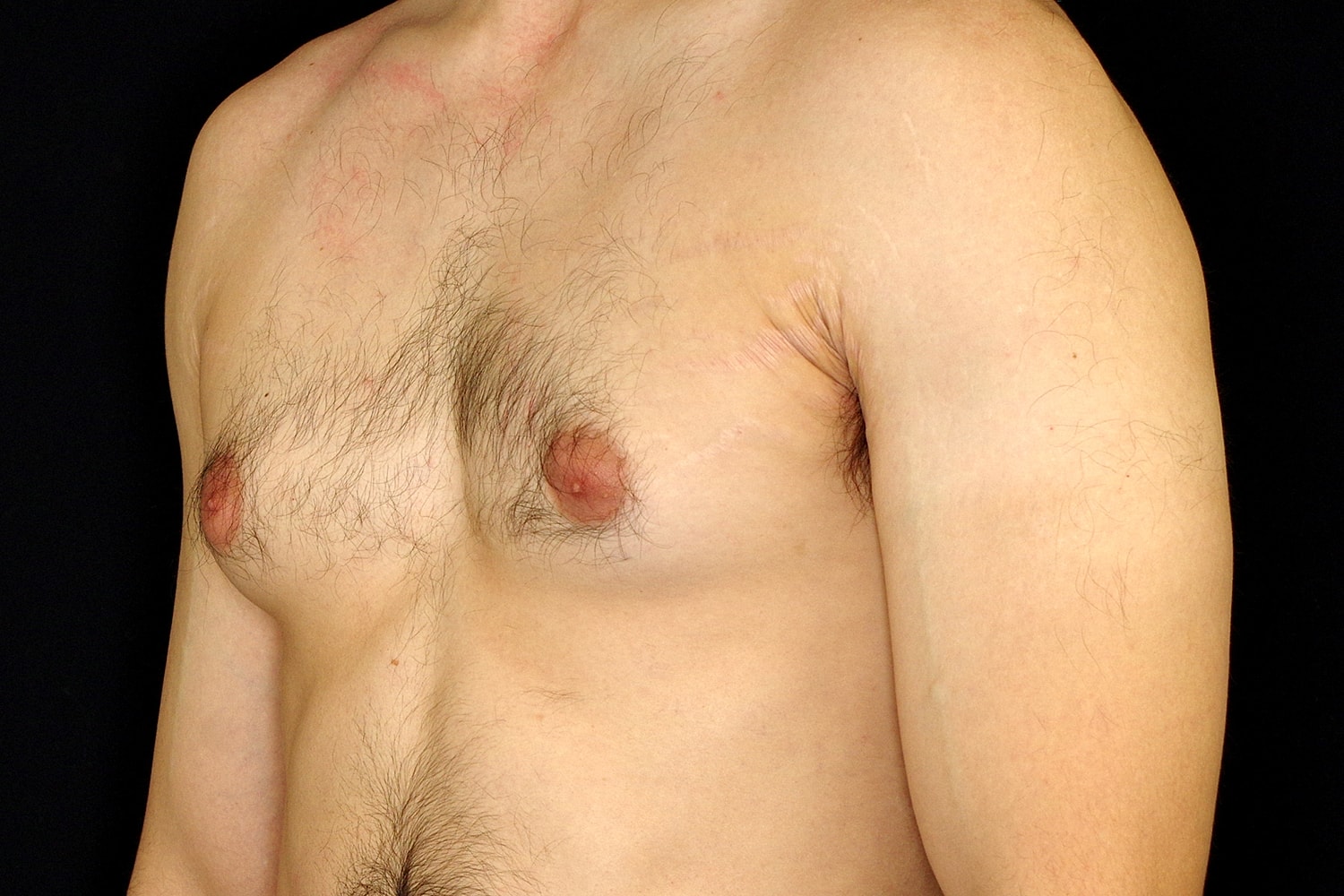 Gynecomastia Before & After