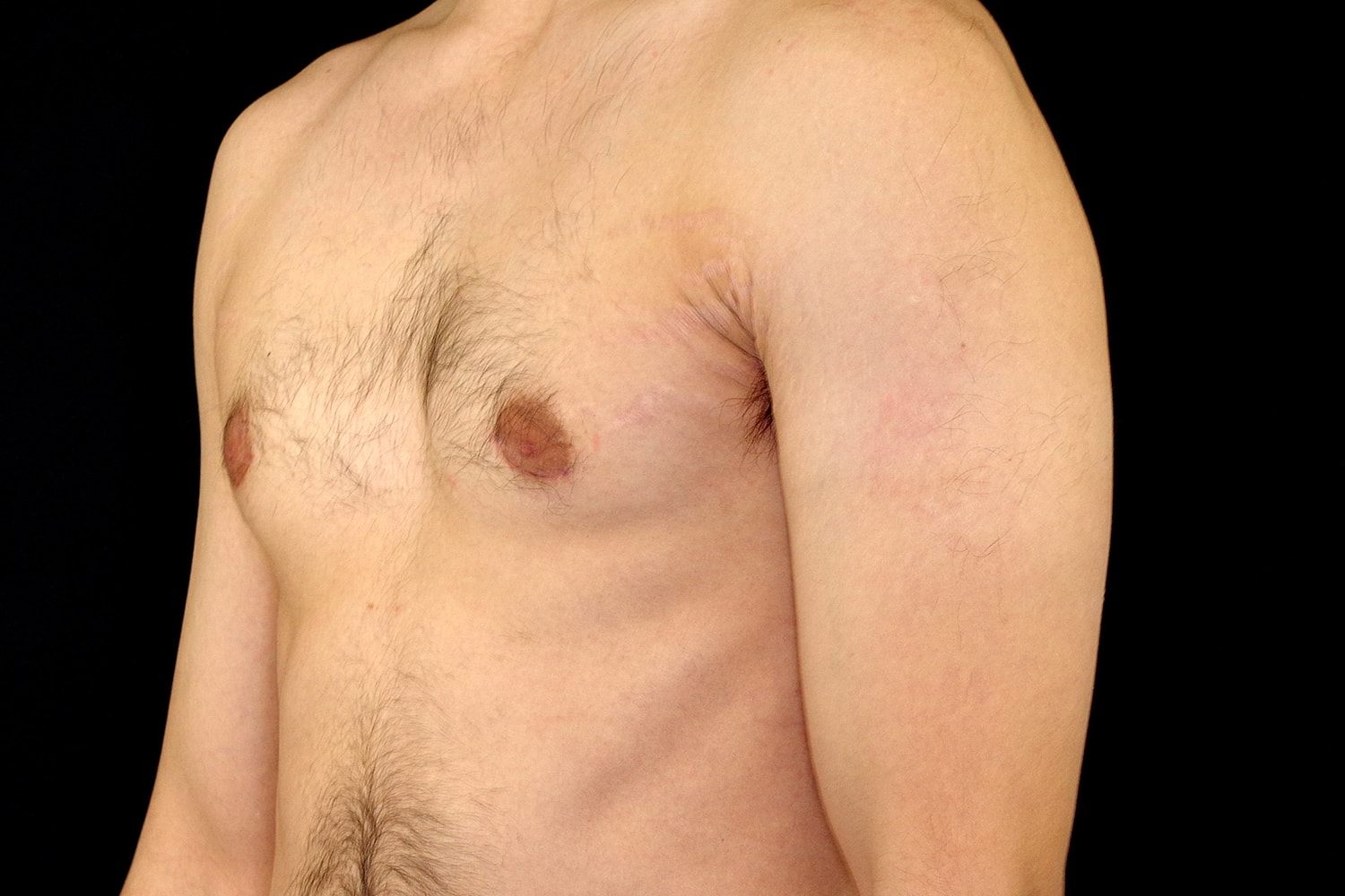 Gynecomastia Before & After