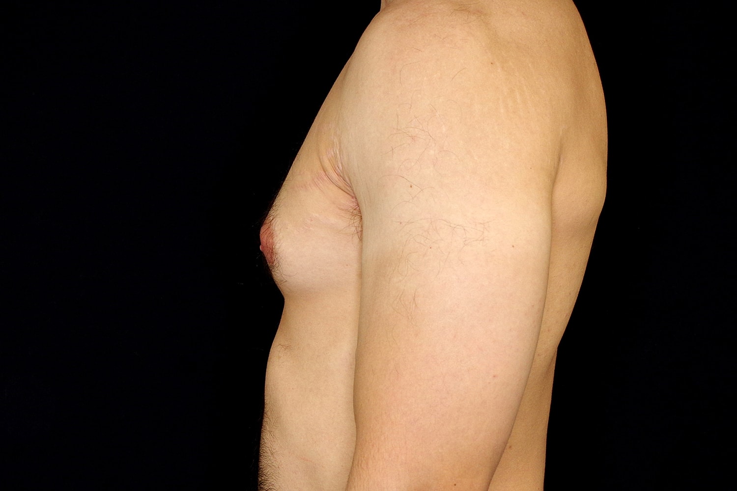 Gynecomastia Before & After
