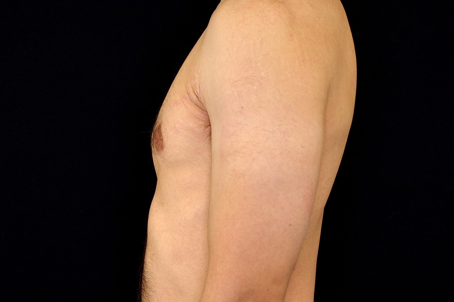 Gynecomastia Before & After