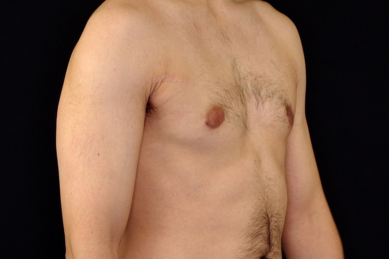 Gynecomastia Before & After
