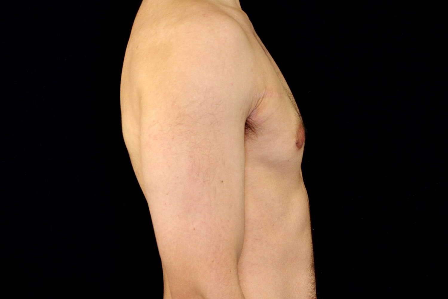 Gynecomastia Before & After
