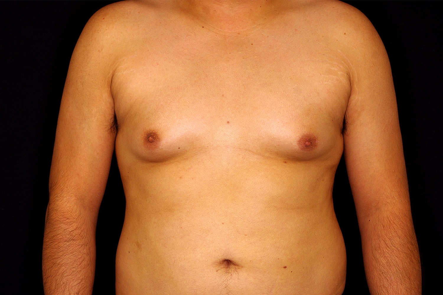Gynecomastia Before & After