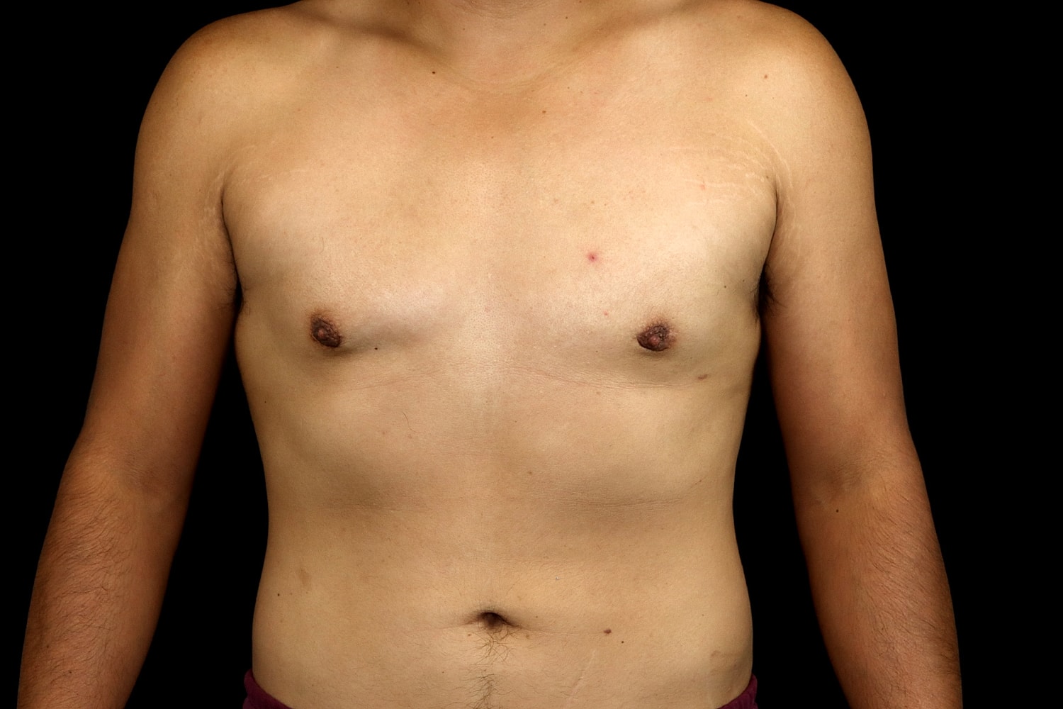 Gynecomastia Before & After